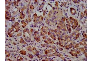 IHC image of ABIN7145595 diluted at 1:500 and staining in paraffin-embedded human pancreatic cancer performed on a Leica BondTM system. (Cholesterol Esterase 抗体  (AA 661-753))