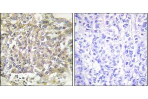 Immunohistochemical analysis of paraffin-embedded human breast carcinoma tissue using Shc (Ab-349) antibody. (SHC1 抗体)