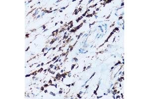 Immunohistochemistry of paraffin-embedded human breast cancer using SPN antibody. (CD43 抗体  (AA 276-400))