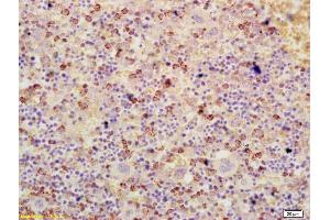 Formalin-fixed and paraffin embedded human colon cancer labeled with Anti-ATF3 Polyclonal Antibody, Unconjugated (ABIN669561) at 1:200 followed by conjugation to the secondary antibody and DAB staining (ATF3 抗体  (AA 51-150))