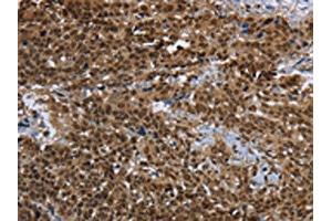 The image on the left is immunohistochemistry of paraffin-embedded Human cervical cancer tissue using ABIN7191991(PRDM2 Antibody) at dilution 1/25, on the right is treated with synthetic peptide. (PRDM2 抗体)