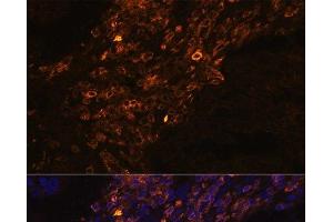 Immunofluorescence analysis of Human lung cancer cells using KRT7 Polyclonal Antibody at dilution of 1:100. (Cytokeratin 7 抗体)