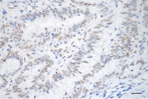 Immunohistochemistry was performed on paraffin-embedded human sigmoid colon carcinoma using TAR DNA binding protein antibody (ABIN7800512), 1:200).