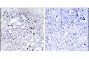 Immunohistochemistry analysis of paraffin-embedded human liver carcinoma, using HNF4 alpha (Phospho-Ser313) Antibody. (HNF4A 抗体  (pSer313))
