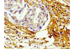 Immunohistochemistry of paraffin-embedded human breast cancer using ABIN7145679 at dilution of 1:100 (BMP1 抗体  (AA 317-424))