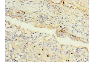 Immunohistochemistry of paraffin-embedded human lung cancer using ABIN7159277 at dilution of 1:100 (MAGEA9 抗体  (AA 1-315))