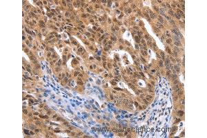 Immunohistochemistry of Human ovarian cancer using MAP2K1 Polyclonal Antibody at dilution of 1:25 (MEK1 抗体)