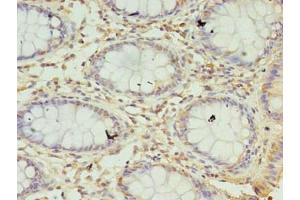 Immunohistochemistry of paraffin-embedded human colon cancer using ABIN7169603 at dilution of 1:100 (SEC11A 抗体  (Catalytic Subunit))