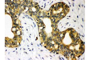 Anti- STAT1 Picoband antibody, IHC(P) IHC(P): Human Mammary Cancer Tissue (STAT1 抗体  (N-Term))