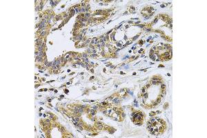 Immunohistochemistry of paraffin-embedded human breast cancer using DRD3 Antibody.