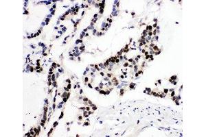 IHC-P: MCM6 antibody testing of human intestinal cancer tissue