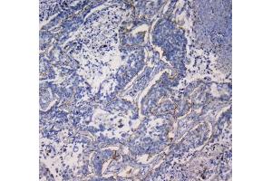 IHC testing of FFPE human lung cancer tissue with ITGA5 antibody at 1ug/ml. (ITGA5 抗体)
