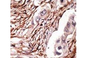 IHC analysis of FFPE human breast carcinoma tissue stained with the NOTCH3 antibody (NOTCH3 抗体  (AA 2291-2321))