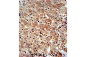 Immunohistochemistry (Paraffin-embedded Sections) (IHC (p)) image for anti-ArfGAP with SH3 Domain, Ankyrin Repeat and PH Domain 3 (ASAP3) (AA 26-54), (N-Term) antibody (ABIN951857)
