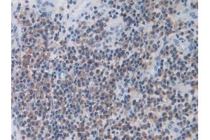 Detection of MX1 in Human Skin cancer Tissue using Polyclonal Antibody to Myxovirus Resistance 1 (MX1) (MX1 抗体  (AA 80-342))