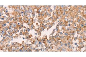 Immunohistochemistry of paraffin-embedded Human breast cancer using GNA11 Polyclonal Antibody at dilution of 1:40 (GNA11 抗体)