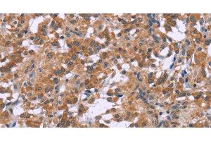 Immunohistochemistry of paraffin-embedded Human thyroid cancer tissue using GNPAT Polyclonal Antibody at dilution 1:40 (GNPAT 抗体)