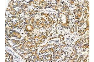 ABIN7095645 and ABIN7099707 at 1/100 staining human colorectal cancer by IHC-P. (KCTD18 抗体)