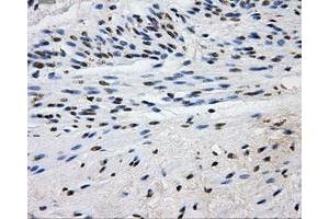 Immunohistochemical staining of paraffin-embedded Carcinoma of liver tissue using anti-L1CAMmouse monoclonal antibody. (L1CAM 抗体)