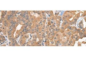 Immunohistochemistry of paraffin-embedded Human thyroid cancer tissue using BCAN Polyclonal Antibody at dilution of 1:35(x200) (BCAN 抗体)