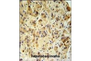 FUCA1 Antibody (Center) (ABIN390762 and ABIN2841020) IHC analysis in formalin fixed and paraffin embedded human hepatocarcinoma followed by peroxidase conjugation of the secondary antibody and DAB staining. (FUCA1 抗体  (AA 265-294))