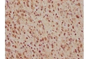 IHC image of ABIN7127412 diluted at 1:165 and staining in paraffin-embedded human glioma cancer performed on a Leica BondTM system. (Recombinant CDC25C 抗体)