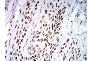 Immunohistochemical analysis of paraffin-embedded esophageal cancer tissues using UFD1L mouse mAb with DAB staining. (UFD1L 抗体  (AA 208-307))