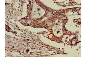 Immunohistochemistry of paraffin-embedded human pancreatic cancer using ABIN7143469 at dilution of 1:100 (GGA3 抗体  (AA 342-503))
