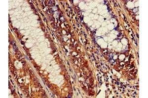 Immunohistochemistry of paraffin-embedded human colon cancer using ABIN7170052 at dilution of 1:100 (ATP1B3 抗体  (AA 57-279))