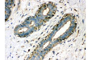 Anti- TGM2 Picoband antibody, IHC(P) IHC(P): Human Mammary Cancer Tissue (Transglutaminase 2 抗体  (N-Term))