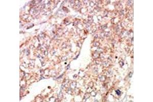 IHC analysis of FFPE human hepatocarcinoma tissue stained with the EphA1 antibody (EPHA1 抗体  (AA 29-60))