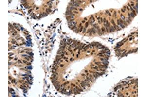 The image on the left is immunohistochemistry of paraffin-embedded Human colon cancer tissue using ABIN7190308(CMTM3 Antibody) at dilution 1/20, on the right is treated with synthetic peptide. (CMTM3 抗体)