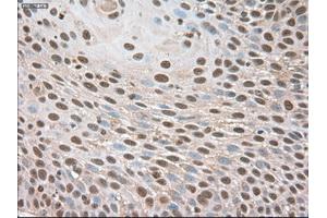 Immunohistochemical staining of paraffin-embedded Adenocarcinoma of breast using anti-Trim33 (ABIN2452535) mouse monoclonal antibody. (TRIM33 抗体  (AA 887-1046))