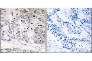 Immunohistochemistry analysis of paraffin-embedded human colon carcinoma tissue, using UBTD1 Antibody. (UBTD1 抗体  (AA 151-200))