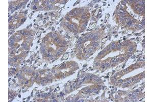 IHC-P Image Immunohistochemical analysis of paraffin-embedded human colon carcinoma, using C14orf94, antibody at 1:500 dilution. (C14orf94 抗体)
