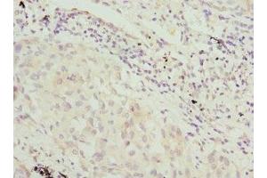 Immunohistochemistry of paraffin-embedded human lung cancer using ABIN7169217 at dilution of 1:100 (VRK1 抗体  (AA 257-396))