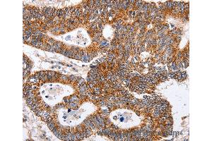 Immunohistochemistry of Human ovarian cancer using MAP2K5 Polyclonal Antibody at dilution of 1:40 (MAP2K5 抗体)