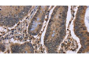 Immunohistochemistry of paraffin-embedded Human colon cancer using DCP1A Polyclonal Antibody at dilution of 1:50 (DCP1A 抗体)