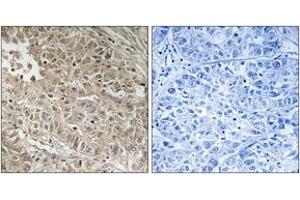 Immunohistochemistry analysis of paraffin-embedded human liver carcinoma tissue, using ABCC13 Antibody. (ABCC13 抗体  (AA 56-105))