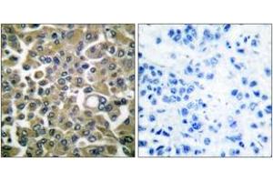 Immunohistochemistry analysis of paraffin-embedded human breast carcinoma tissue, using Keratin 16 Antibody.