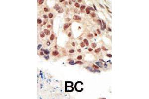 Formalin-fixed and paraffin-embedded human cancer tissue reacted with PRKG2 polyclonal antibody  , which was peroxidase-conjugated to the secondary antibody, followed by AEC staining. (PRKG2 抗体  (C-Term))
