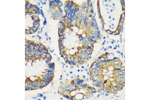 Immunohistochemistry of paraffin-embedded Human colon carcinoma using USP47 Rabbit pAb (ABIN7271166) at dilution of 1:100 (40x lens). (USP47 抗体  (AA 1128-1287))