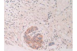 IHC-P analysis of Human Pancreas Cancer Tissue, with DAB staining. (Chordin 抗体  (AA 700-918))
