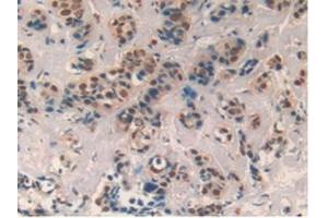 Detection of CXCL7 in Human Breast cancer Tissue using Polyclonal Antibody to Chemokine (C-X-C motif) ligand 7 ( CXCL7) (CXCL7 抗体  (AA 59-128))