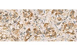 Immunohistochemistry of paraffin-embedded Human liver cancer tissue using VTA1 Polyclonal Antibody at dilution of 1:60(x200) (VTA1 抗体)