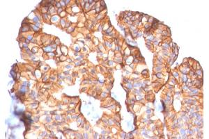 Formalin-fixed, paraffin-embedded human Breast Carcinoma stained with HER-2 Mouse Monoclonal Antibody (ERBB2/2452). (ErbB2/Her2 抗体  (AA 311-462))