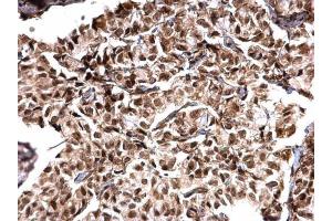 IHC-P Image MTA1 antibody [C1C3] detects MTA1 protein at nucleus on human breast carcinoma by immunohistochemical analysis. (MTA1 抗体)