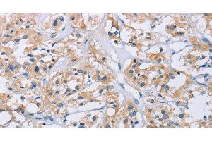 Immunohistochemistry of paraffin-embedded Human thyroid cancer tissue using CCR9 Polyclonal Antibody at dilution 1:60 (CCR9 抗体)