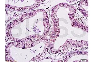 Formalin-fixed and paraffin embedded human gastric carcinoma labeled with Anti-WWOX Polyclonal Antibody (ABIN670551), Unconjugated at 1:200, followed by conjugation to the secondary antibody and DAB staining (WWOX 抗体  (AA 5-100))