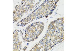 Immunohistochemistry of paraffin-embedded human esophageal cancer using IKBKG antibody (ABIN5970336) at dilution of 1/100 (40x lens).